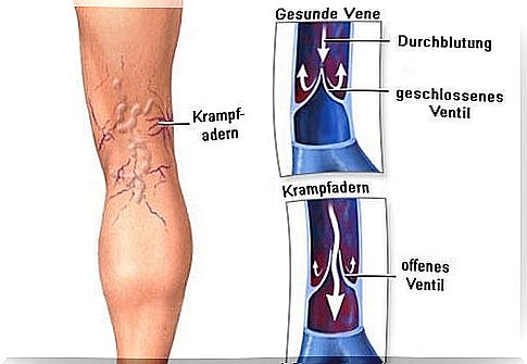 10 herbal home remedies for varicose veins