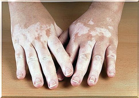 5 home remedies to take care of your skin for vitiligo