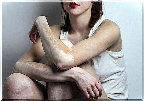 Vitiligo