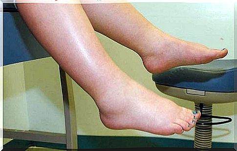 fluid-retention-in-legs-due-to-a-kidney-disorder