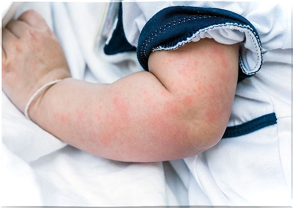 Rash in babies: what to do