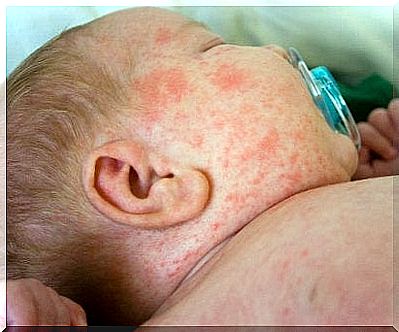 Rash in babies