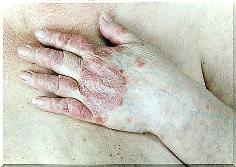 Can you control psoriasis?