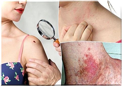 Detecting skin cancer in time: 6 symptoms