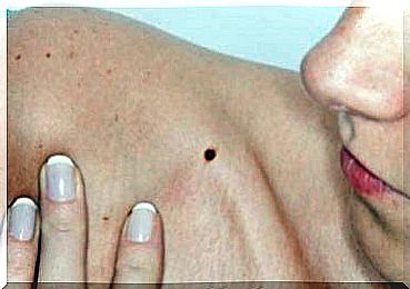 Detect skin cancer in good time through altered pigment spots