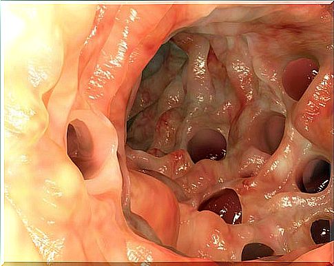 Interesting Facts About Diverticulitis