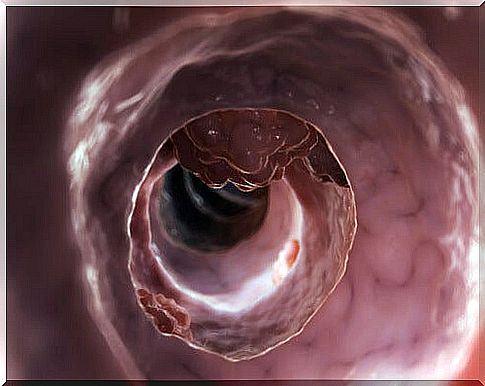 Diverticulosis-or-diverticulitis