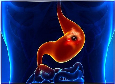 Gastric ulcer: symptoms and measures