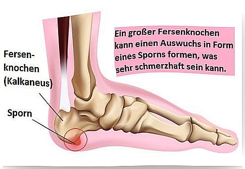 Heel Spur - What Can I Do?