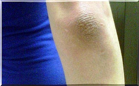 How to tackle dark discoloration on your elbows and knees