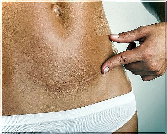 Reduce the scar after a caesarean section with scar ointment