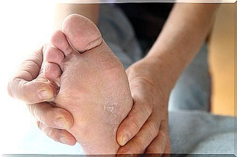 Natural home remedies for athlete's foot