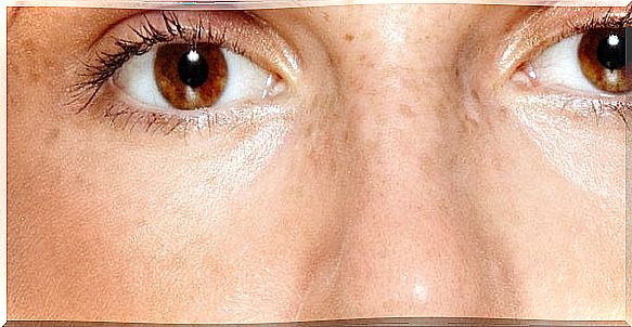 How do you reduce skin spots caused by hyperpigmentation?