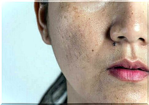 Skin changes - pigment spots