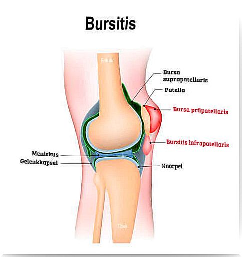 more about bursitis