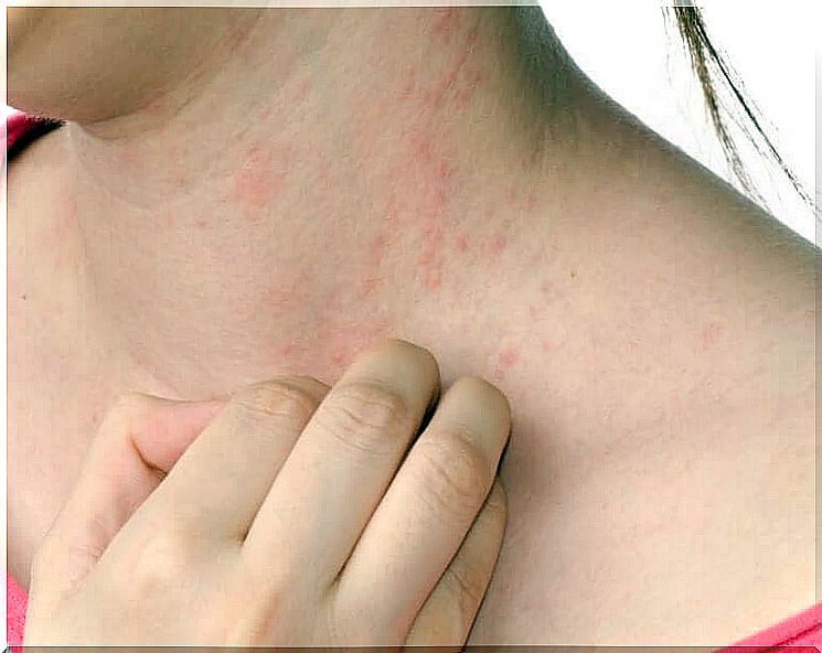 Neurodermatitis: symptoms and diagnosis