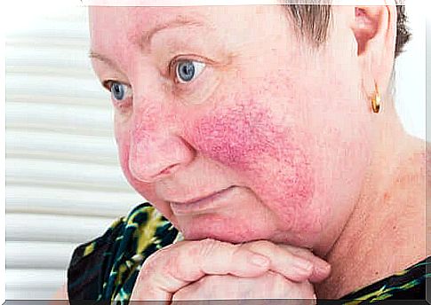 Woman with rosacea