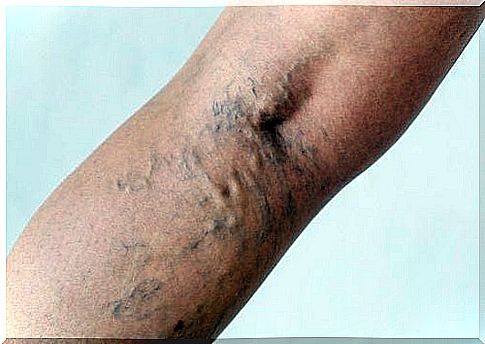 Varicose veins: herbal remedies can prevent them