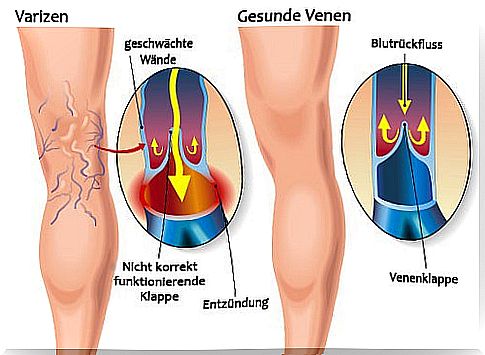 varicose veins