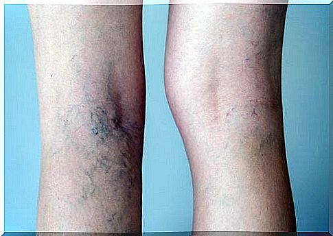 herbal home remedies for varicose veins