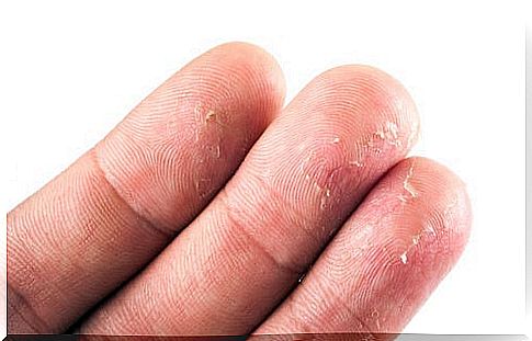 Eczema